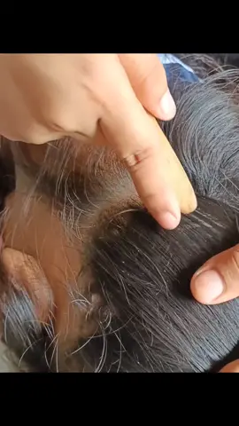 OMG 😱😱😱 đã loại bỏ chấy  #fypシ゚viral #fypシ #viral #foryou #lice #tick #fyp #liceremoval #omg 