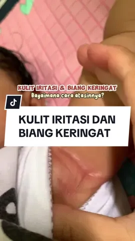 Akhirnya sekarang gak worry lagi kalo kulit baby iritasi dan kemerahan akibat biang keringat😍 #biangkeringat #kulitiritasi #kulitbayi #kulitsensitif #skinrescuebalm #gently 
