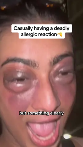 I didn’t know what was happening to my face🫢 @SHIV #allergicreaction #allergycheck #allergic #hospital #fyp 