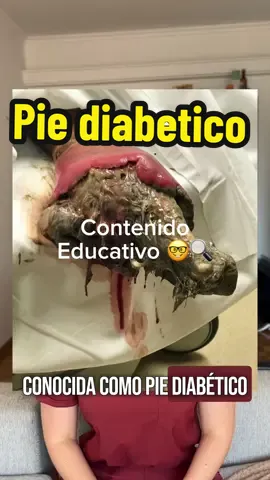 Pie diabetico 