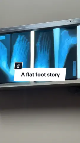 Putting my severe flat feet on display. Hopefully I’m not the only one who suffers from this 😅#podiatry #flatfeet #tendinitis #footsurgery ?