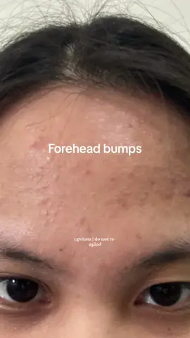 Disclaimer: what works for me might not work for you.  Hindi pa super kinis pero look at the improvement 🥹 #foreheadacne #foreheadbumps #humannature #teatree #skincare #skincareroutine #skincare 