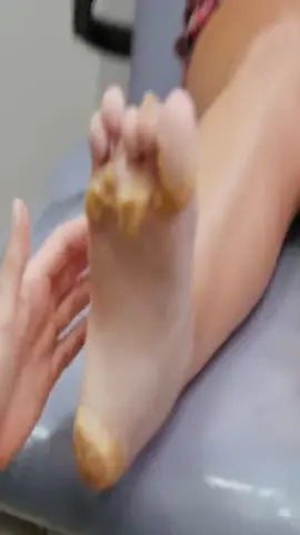 The doctor has successfully treated the unfortunate girl’s foot fungus.#poorgirl #mushroomfeet #foot #health  #doctor #surgery #hospital 