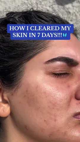 My Clear Skin Routine✨🦋 #foryoupage #foryou #trending #skin #skincare #clearskin #acne #acneskin #asiangirl #desi
