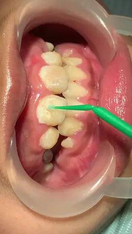 Mảng bám răng trên răng của các bé hình thành ra sao. #chữatuỷ #bacthanhchuatuy #dieutrituyrang #rangtreem #chetuy #xuhuong 