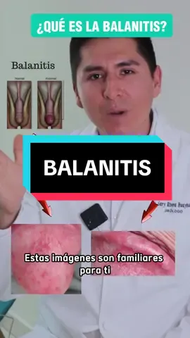 ATENCION VARONES HUANCAYO🚨 ¿SABES QUE ES LA BALANITIS?  Cuida tu salud masculina informandote  • • • • #balanitis #enrojecimiento #urologo #huancayo #medicos #hombres #salud 