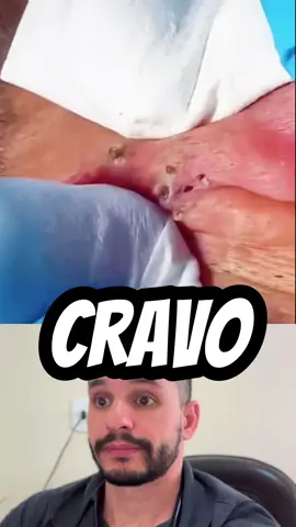 Os cravos, também conhecidos como comedões, são uma condição comum da pele em que os poros ficam entupidos com sebo (óleo) e células mortas da pele. Eles aparecem como pequenos pontos escuros ou brancos na superfície da pele e geralmente se formam na zona T do rosto (testa, nariz e queixo), embora possam ocorrer em outras áreas do corpo também.  Os cravos pretos são abertos e expostos ao ar, o que faz com que o sebo oxidado fique escuro, dando-lhes uma aparência escura. Já os cravos brancos são fechados e o sebo não é exposto ao ar, fazendo com que eles pareçam pequenas protuberâncias brancas na pele.  Embora os cravos não sejam prejudiciais à saúde, podem ser incômodos do ponto de vista estético e, em casos mais graves, podem levar a outras condições da pele, como acne. É importante manter uma rotina de cuidados com a pele, como lavar o rosto regularmente e usar produtos adequados para o seu tipo de pele, a fim de prevenir a formação de cravos e outros problemas da pele. #cravo #pimpe #skincare