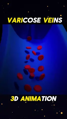 Varicose veins 3d animation #varicose #veins #varicoseveins  #animation  #medical #Science  #veins #artries 
