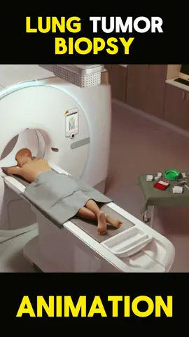 Lung Tumor Biopsy 3d animation procedure  #lungtumor #biopsy #animation #medical #lungtumor  #tumor  #lung  #medicalstudent  #animation #health  #medicalstudent  #animation #video #lungbiopsy #biopsy #lungcancerbiopsy #lungbiopsyprocedure #tumor #needlebiopsy #lungtumorbiopsies #lungs #tumors #openlungbiopsy 