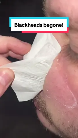 Nobodymlike stinky poopoo caca blackheads #fyp #tiktokshop #tiktokmademebuyit 