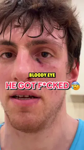 Y’all see my dunk at the end 😈 @Sam #injury #basketball #ballislife #NBA #hooper 