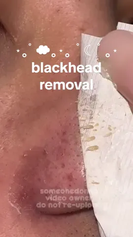 Ang daming natanggal grabe! 😱#rtopr #rtoprmango #blackhead #blackheadsremoval #blackheadextraction #smallaffiliate #tiktokaffiliatemarketingbeginner #tiktokaffiliatemarketing  Salicylic Acid For Blackheads blackhead satisfying extraction satisfying blackhead removal back head removal White Head Removal blackheads removal blackhead skin care blackheads remover mask blackhead remover tool blackheads treatment blackheads satisfying removal blackheads removal products blackheads removal set blackhead removal asmr Satisfying satisfying removal black pimples remove blackheads satisfying