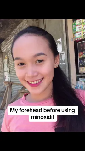 #minoxidil     #minoxidilresult   #minoxidilchallenge   #minoxidiloriginal #minoxidilresultado   #minoxidilresults 