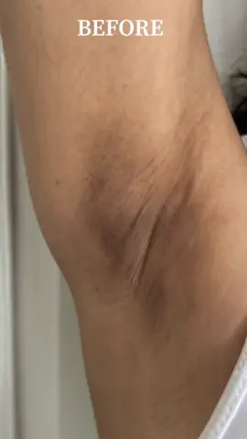 Ya no tendrás que esconder y tapar tus axilas manchadas,  porque aquí te tenemos la solución a todos tus problemas. Crema Aclaradora de Axilas Sadoer con Vitamina C. Disponible en nuestro catálogo 👇 https://bodega-mayorista-luna-valen.kyte.site 📍Estamos ubicados en cali  ✅ Somos Bodega Mayoristas 📈 Tenemos ventas al por mayor y al detal ❌ Sin montos mínimos de dinero ni productos por referencia 🚚 Pago contra entrega en todo el país 📱Línea de servicio al cliente wasap 3165066111