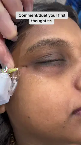 Carboxytherapy on point.  #Love #aesthetic #facial #carboxytherapy #fypシ #aesthetic #fypシ #fyp #fypシ゚viral #video #dubai #skincare #FREAKY #beautiful #rotterdam 