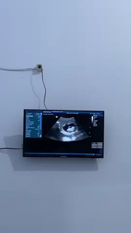 Usg pertama wktu adik bayi umur 3 bulan Sehat selalu cintaku see you di bulan 6 yah 🥰#pejuanggarisdua#anugrahterindah#fyppppppppppppppppppppppp#viralvideo 