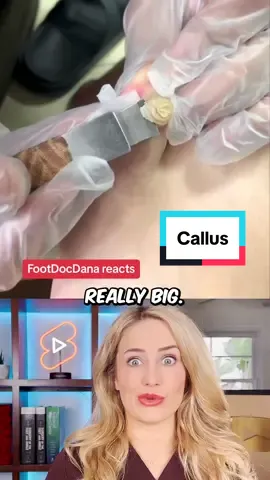 Reacting to a HUGE callus on the toe!  #callus #doctor #doctorreacts #doctorsoftiktok #learnsomethingnew #medical #surgery #medicalvideos #doctors #podiatry #podiatrist #footsurgeon #surgeon #surgeons #nurse #nurses #healthcare #scrublife #medicalhumor #scrubslife #podiatric #medicine 