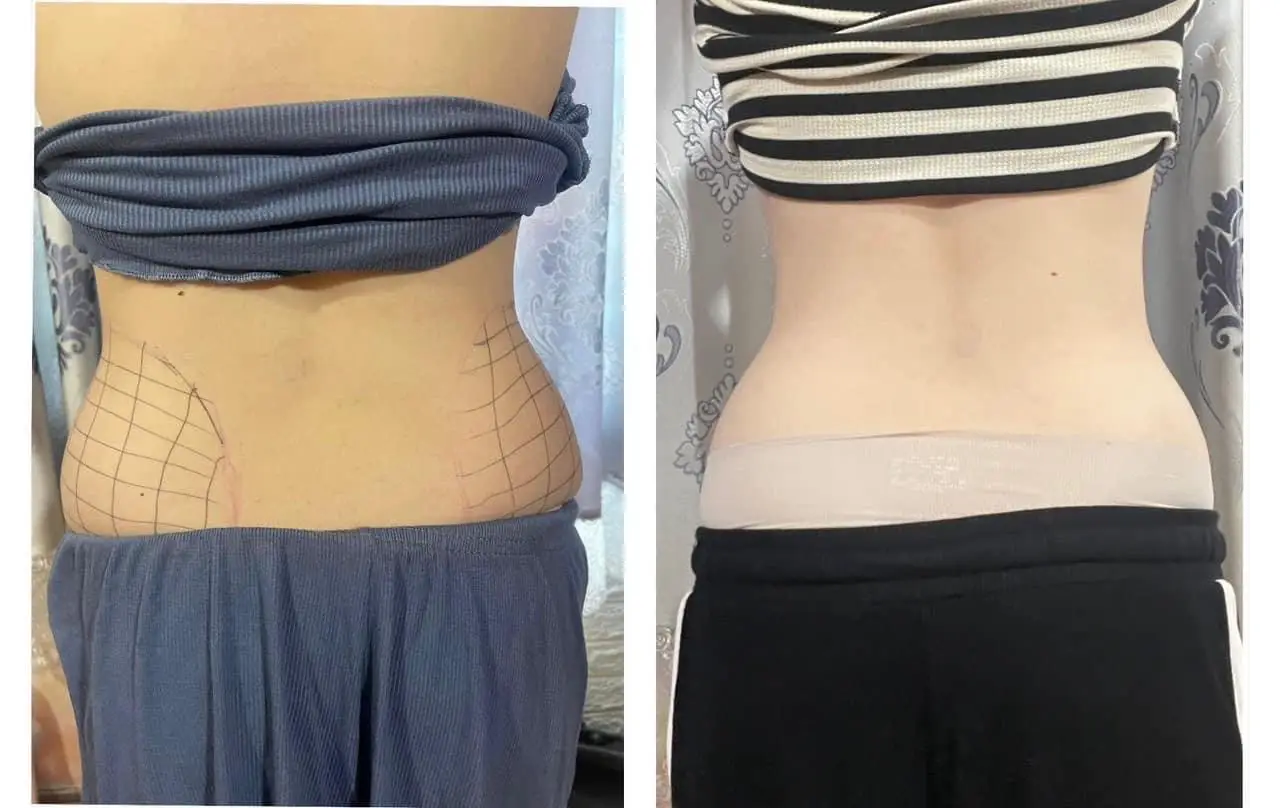 Tiêm tan mỡ cho ce đây ạ,mỡ bụng lâu ngày k giảm muốn giảm vùng naod t ngay vùng đó ,An toàn hiệu quả nhanh.IB EM TV Ạ #THẢOMYCLINIC👄👄  #làm_đẹp_tại_nhật_bản  #tiêmtanmobung 