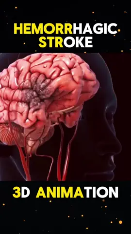Hemorrhagic Stroke 3d animation  #hemorrhagicstroke #stroke #hemorrhagicstroketreatment #ischemicstroke #hemorrhagicstrokediagnosis #subject  #stroketreatment