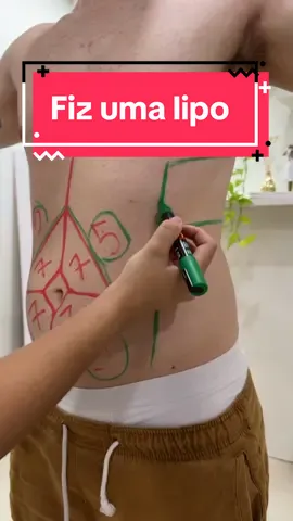 FIZ UMA LIPO POR MENOS DE 3MIL!! Isso mesmo hahaha o resultado de uma lipo custando muitas vezes menos! Para perder mais facilmente a gordura localizada que não sai de jeito nenhum, a @revitalizzeclinica oferece a Criolipolise como uma saída para quem não quer ir para a faca!! Claro, custando muito menos e quase sem desconforto. Comenta aí pra eu mostrar o resultado hoje em dia #marechal #marechalrondon #toledo #criolipolise #emagrecimento #gorduraabdominal #gordura #Fitness #dieta 