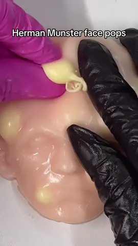 They  are cysts !! #hermanmunster #themunsters #themunstersfamily Satisfying??  #asmrsounds #asmr #viral #fypシ #relax #skincare #mouthsounds #satisfying #tingles #asmrtriggers #mochipimplepopping #pimplepoppin #acnetreatment #asmrtiktoks #asmr_tingles 
