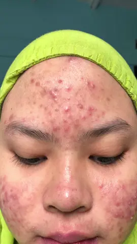 Aku udah pake ini dari 3 tahun yang laluu, Ini face wash yang paling aman buat acne pronee, dan dia juga aman buat fungal acne🥹🫶🏻✨#acnefighter #acneskin #acne #skincareroutine #facewash 
