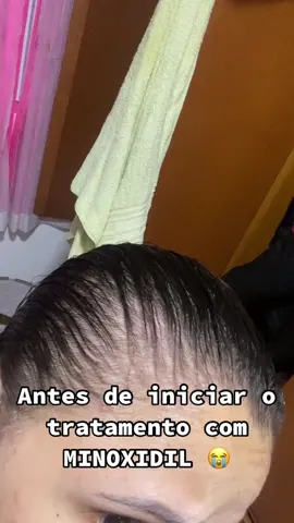2 meses usando o MINOXIDIL✨💁🏻‍♀️ #minoxidil #quedadecabelo #fy 