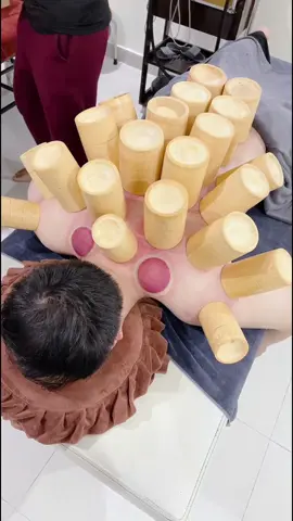 [ASMR] Bamboo tube Cupping Therapy #Giachoi #trilieuhaiphong #xuhuong #massage 
