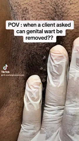 Genital warts present as outgrowths on genital areas. They start off as tiny skin-colored or whitish bumps, & grow to resemble little pieces of cauliflower. You can have just one wart or a bunch of them, and they can be big or small. They might be itchy, but most of the time they don't hurt. The fastest way to get rid of genital warts is with a fibroblast procedure . Book a session with us today 🙏🙏