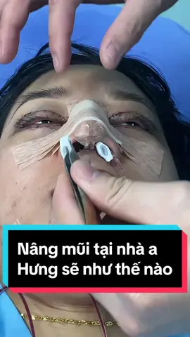 ✅Nâng mũi tại nhà anh Hưng sẽ như thế nào #thammytoandien #catmiphuong #nangmuicautruc #nangmuiphongthuy #phauthuatthammy 