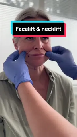 Only 5 days after deep facelift and deep necklift👌🏻 What do you think? All done in local anesthesia😉 📲 If you want to make an appointment, contact us at info@v-clinic.cz #facelift #necklift #plasticsurgery #plasticsurgeon #plastickachirurgie #ventruba #vclinic #transformation #beforeandafter