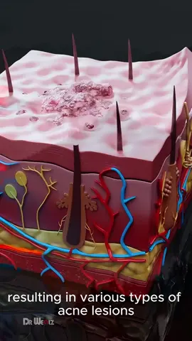 What Exactly Is Acne, Causes of Acne- 3D Animation #medical #doctor#stpatricksday #liverpool #gataonly #facup #domingo