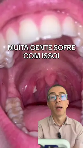 Vc sofre com isso? Os caseum (ou caseo) causam muito incômodo e mau hálito. Muitas vezes são confundidos, nas emergências, com placas de pus. Antibióticos são prescritos sem necessidade. Tem 2 tratamentos possíveis: o gargarejo e a cirurgia. Gargarejo: 1 🥛de água morna (300ml) 1 🥄 de chá de sal 1 🥄 de chá de bibarbonato de sódio Gargarejar sempre após escovar os dentes. Já fez esse gargarejo? Funcionou pra vc? #amigdalas #amigdalite #ronco #apneia #caseum #caseo #mauhalito #drcarlosotorrino #otorrinolaringologia #otorrinobrasilia #otorrinobrasília #otorrino