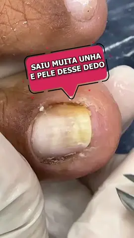 Saiu muita unha e muita pele desse dedão..#ingrowntoenailremoval #unhaencravada #ingrowntoenail #unhasencravadas #uñaencarnada 