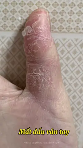 Bong da tay, ngứa ngáy khó chịu than khảo ngay nha📍🧷