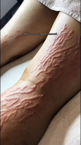 Bye bye striae! Over 6 weken zullen wij het resultaat delen 🫶🏼 #stretchmarks #stretchmarksremedy #stretchmarksolution #stretchmarktreatment #stretchmarkremoval #viral 
