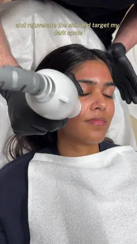 🚨Results at the end! 🤯 Here’s everything you need to know about RF microneedling: Microneedling is done to stimulate collagen production and improve texture. Radio frequency penetrates the skin deeper to produce faster results. This combined treatment is great for tightening skin and alleviating the appearance of acne scars, fine lines and uneven texture.  Numbing cream helps a ton! This was a 3/10  on the pain scale for me.  After the needling, your face will be red and slightly inflamed. This means it’s working! My redness went away over night and I woke up with glowing skin. The next few days, when I looked reallly closely I noticed little tiny dots/scabs where the needles went into my skin. My skin was healing and those went away after a few more days. By the end of the week, I noticed my skin was glowing and my scars weren’t as dark! I think some of the lighter scars even went away completely! 📍MOMADerm  Midtown, NYC Would you try this?  Let me know and drop your questions in the comments!  @💉 Dr Charles MD 💉 @MOMADerm 