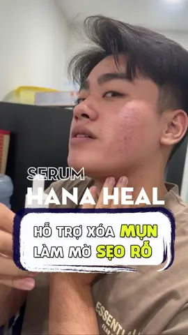 Series 5 | Chia sẻ thực tế trải nghiệm sau hơn 30 ngày của Thái khi sử dụng serum hỗ trợ làn da bị Mụn và Sẹo rỗ của mình. #osaci #osacivietnam #osacicosmetic 