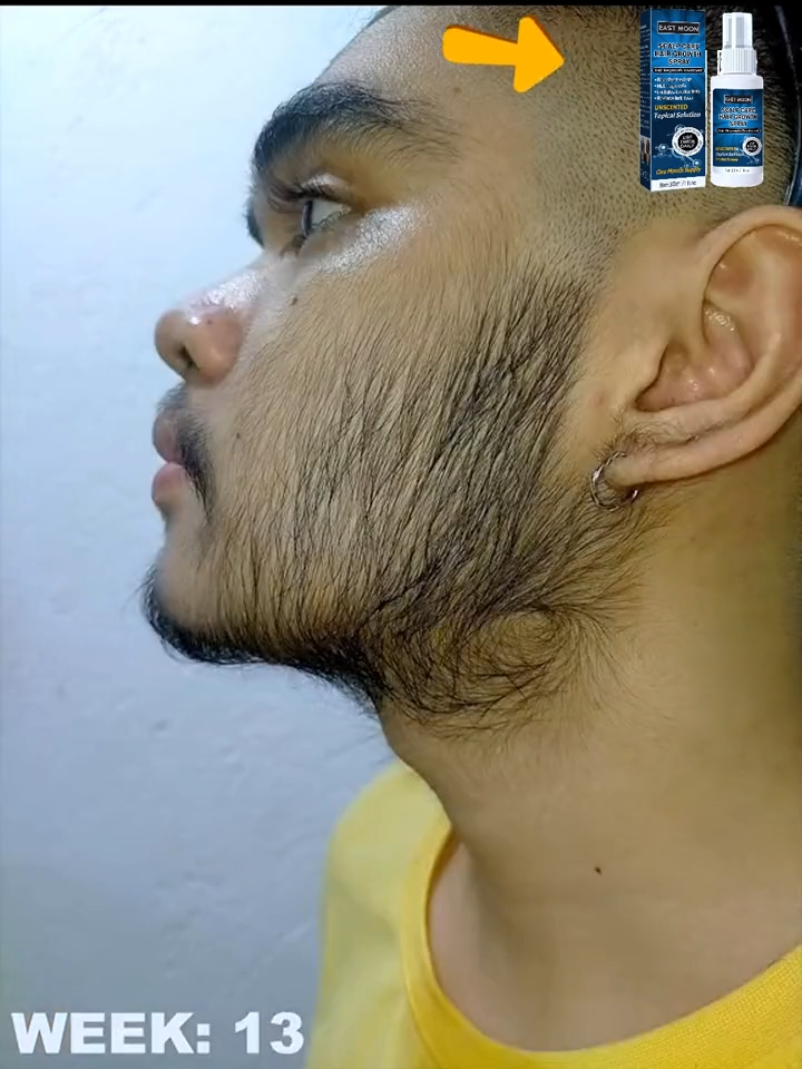 Say no to hair loss and baldness.Use it and you will find amazing things....The secret weapon for hair growth, this product can effectively make your hair grow quickly .Also suitable for beards#hair  #baldness  #hairgrowth  #hairloss  #haircare  #recommend  #foryou  #beard  #like  #Love  🌹🌹🌹