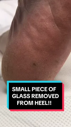 This patient stepped on a tiny piece of glass. She felt much better as soon as it was completely removed. #fyp #foryou #foryoupage #viral #sydney #australia #podiatry #corn #feet #foot #satisfying #glass 