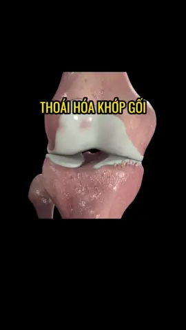 Nghe nhiều nhưng bạn có biết: Thoái hóa khớp gối diễn ra như thế nào ? #bscuongphcn #vatlytrilieu #phuchoichucnang #thoaihoakhop #daukhopgoi  #LearnOnTikTok 