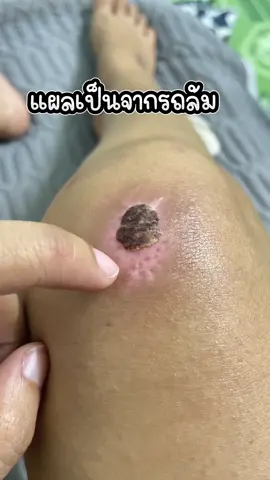 ล้มว่าอายแล้วรอยแผลเป็นอายกว่า #อีใบรีวิว #tiktok #แผลเป็น #รอยแผลเป็น 