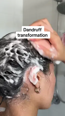 It finally went away 🥹🥹 #dandruff #scalpcare #scalpscrubber #haircare #skincare #hairhack