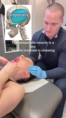 🤔Understanding Temporalis Muscle Pain ▪️ Anatomy: The temporalis muscle, located on the side of the head, facilitates jaw movement and chewing. ▪️ Symptoms: Temporalis muscle pain manifests as discomfort in the jaw, temples, and surrounding areas, often worsening during activities like chewing or talking. ▪️ Causes: Overuse, tension, or strain on the temporalis muscle, often due to habits like teeth clenching or grinding, can lead to pain and temporomandibular joint (TMJ) dysfunction. #TemporalisPain #TMJ #JawDiscomfort #MuscleStrain #ChronicPain #DentalHealth #dryneedling #MyofascialRelease #DryNeedling #CuppingTherapy #MuscleHealth #FascialHealth #PainRelief #chicagochiropractor #roscoevillage #activereleasetechniques #drkyleross