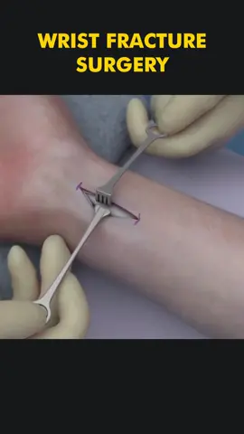 Wrist Fracture Repair Surgery 3D Animation - Distal Radius Fracture Repair  #wristfracture #wristfractured #wristfracturerecovery #distalradiusfracture #distalradiusrepair #distalradiusrepair #distalradiusosteotomy #distalradiusbreak #medical3danimation #3dmedicalanimation #medicalprocedure 