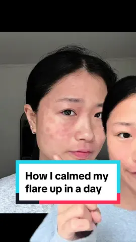 Sucessfully calmed my facial flare in a day!✨🫶🏻 #eczema #flareup #eczemaflareup #tsw #dupixent #dupixentjourney #facialflare #sensitiveskin #redface #dryskin #deadseasalt 