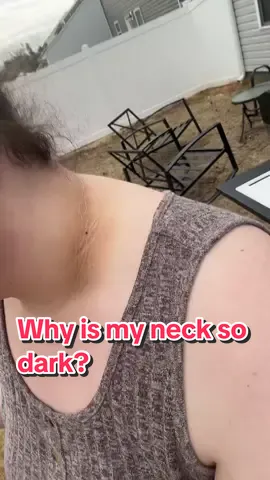 No, it is not dirt! Here’s how to get rid of the darkness around your neck #acanthosisnigricans #pcos #insulinresinresistance #darkneck #pcosweightloss #diabetes #darkneckremedy 