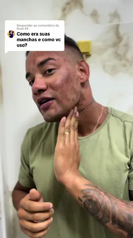 Respondendo a @Ruan Eli nesse video mostro como tava antes, como usei e como esta atualmente #skincare 