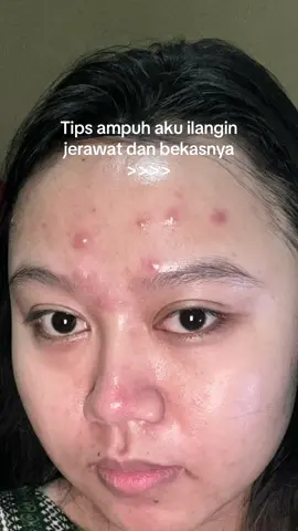 Siapa yang sering jerawatan kek bisul juga?💔🤮 #fyp #acnespot #viralskincare #obatjerawat #acnefighter #jerawatan 