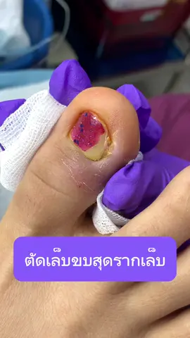 ปัญหาเล็บขบที่เจอบ่อยที่สุด คือการตัดเล็บขบด้วยตัวเองแล้วเอาไม่ออกคะ #wefootตัดเล็บขบรักษาเล็บเชื้อรา #ingrowntoenail #เล็บขบอักเสบ #ตัดเล็บขบมียาชา #เล็บขบ #เล็บขบหนักมาก #ตัดเล็บขบ 